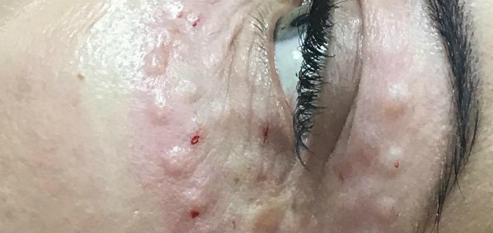 Mesotherapy