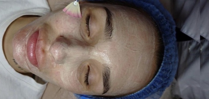 Лікування акне в Perfect Cosmetology у Києві. Записуйся по знижці.